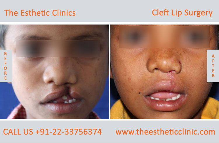 cleft lip surgery, Unilateral Cleft Lip Repair Treatment before after photos in mumbai india (1)